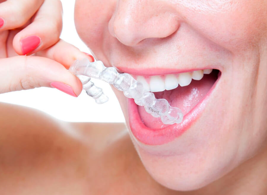 invisalign