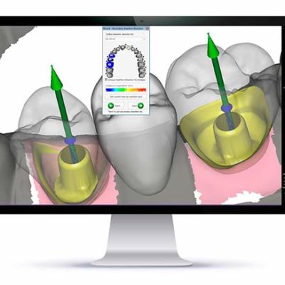 implantes-cad-cam-leganes