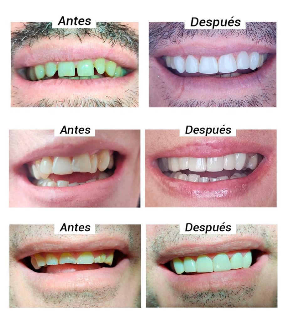 https://www.clinicadentalzahne.es/wp-content/uploads/2023/03/carillas-dentales-antes-y-despues-922x1024.jpg