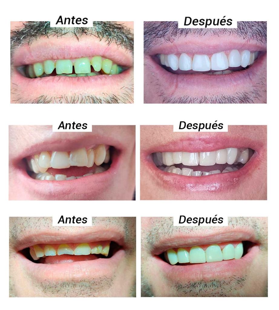 Carillas de composite