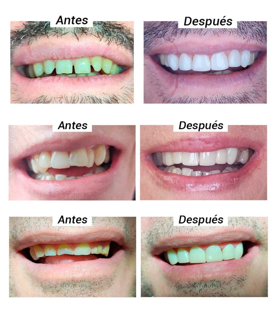 Carillas dentales de composite - Clínica Dental Zahne