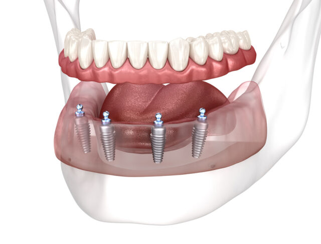 sobredentadura-implantes-leganes