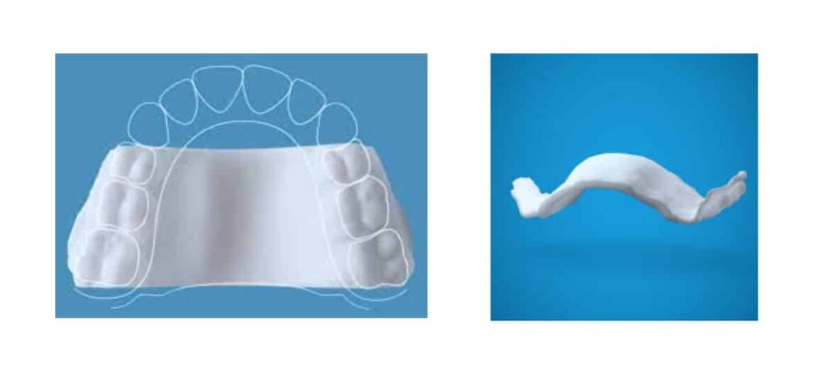 Expansor Palatino Invisalign
