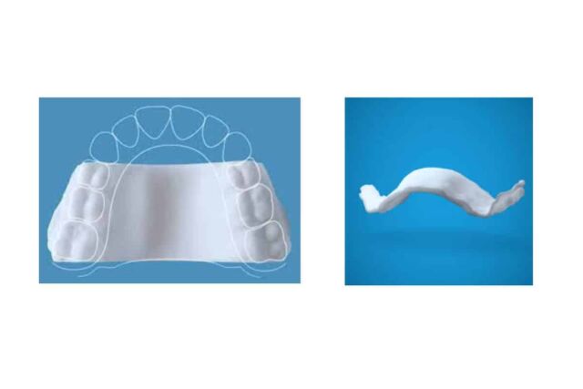 Expansor Palatino Invisalign