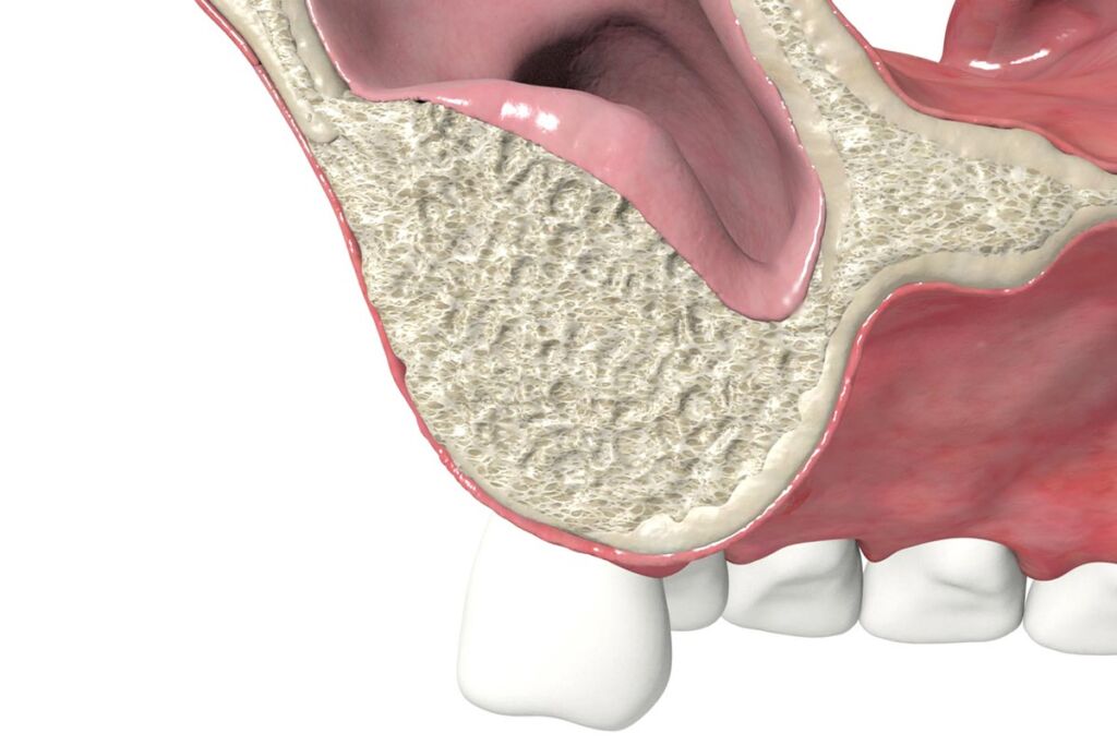¿Puedo ponerme implantes dentales si no tengo hueso?