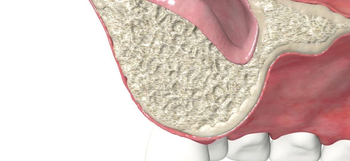 puedo-ponerme-implantes-dentales-si-no-tengo-hueso