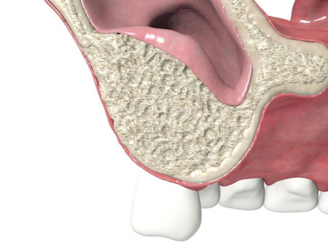 puedo-ponerme-implantes-dentales-si-no-tengo-hueso