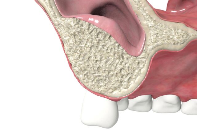 puedo-ponerme-implantes-dentales-si-no-tengo-hueso
