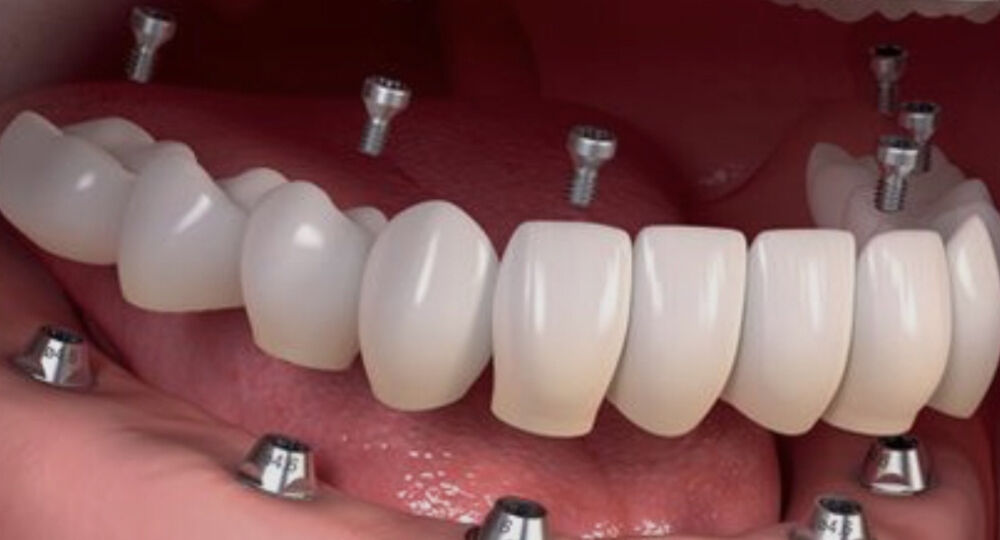 tipos-protesis-dentales-fijas