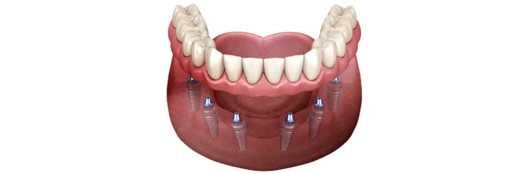 Rehabilitaciones completas con prótesis fija All on Six: la mejor alternativa a la sobredentadura