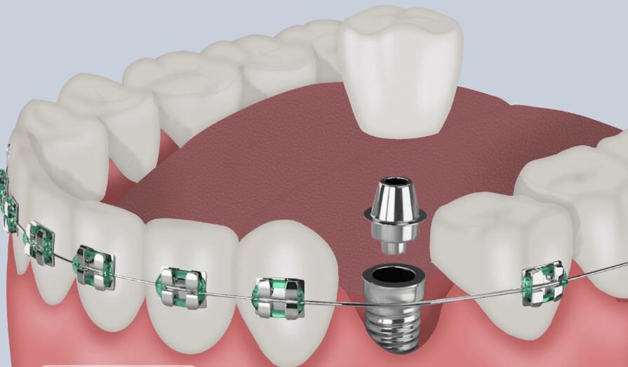 ¿Se puede poner ortodoncia con implantes dentales?